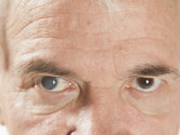 Older man with Cataracts